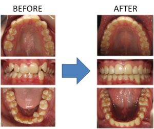 A before and after of someone's mouth who had braces. 