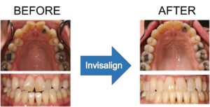 A before and after of someone's mouth who used Invisalign. 