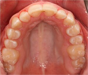 Picture of the top of someone's mouth who uses a orthodontic retainer.